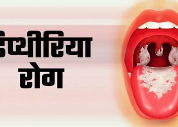मासूम बच्चे में गलघोंटू (डिप्थीरिया) के मिले लक्षण, जांच के लिए भेजा गया सैंपल